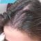 Traitements de la chute des cheveux
