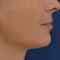 Facelift