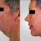 Facelift