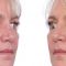 Lipofilling, Lipotransfer (aplikácie vlastného tuku)