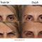 BOTOX® / DYSPORT®, Botulina - pentru îndepărtarea ridurilor.