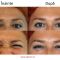 BOTOX® / DYSPORT®, Botulina - pentru îndepărtarea ridurilor.