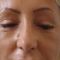 Lifting facial