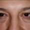 Blefaroplastie