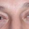 Blefaroplastie