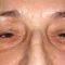 Blefaroplastie