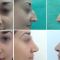 Rinoplastie