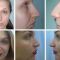 Rinoplastie