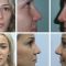 Rinoplastie