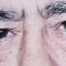 Blépharoplastie