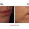 Mole removal