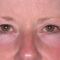 Ultherapy