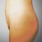 Liposuction