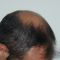 Trapianto capelli