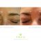 Teosyal, Restylane, Esthelis, Juverdem, Surgiderm (preparáty kyseliny hyaluronovej)