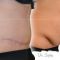Abdominoplastika (Operácia brucha)