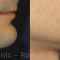 Chin Surgery