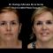 Lifting facial