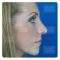 Operácia nosa (Rhinoplastika)