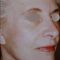 Lifting du visage