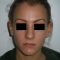 Otoplastie (Chirurgie esthétique des oreilles)