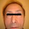 Blépharoplastie