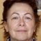 Operácia očných viečok (Blepharoplastika)