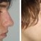 Rhinoplasty (Nose Job)