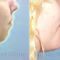 Chin Surgery