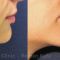 Chin Surgery