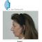 Lifting du visage