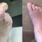Bunion surgery (hallux valgus)
