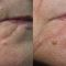 Fractional Laser Resurfacing
