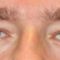Korekcja powiek (Blepharoplastyka)