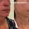Lifting du visage