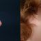 Plastika nosu (Rhinoplastika)