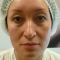 Injections de comblement