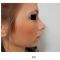 Plastika nosu (Rhinoplastika)