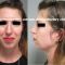 Rhinoplastie