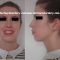 Rhinoplastie
