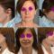 Facelift, SMAS facelifting