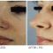 Rhinoplasty (Nose Job)