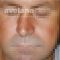Operácia nosa (Rhinoplastika)