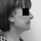 Lifting du visage