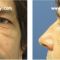 Blépharoplastie