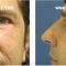 Blépharoplastie
