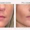 Kwas hialuronowy: Saypha, Restylane, Juvederm, Stylage