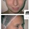 Rhinoplastie