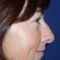 Plastika nosu (Rhinoplastika)
