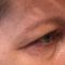Korekcja powiek (Blepharoplastyka)